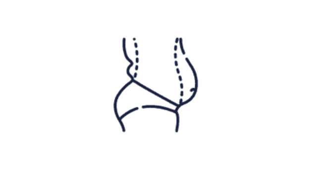 Abdominoplastie